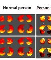 The picture shows a far better gas transport in a person with no lung diseases in contrast to a person with asthma.